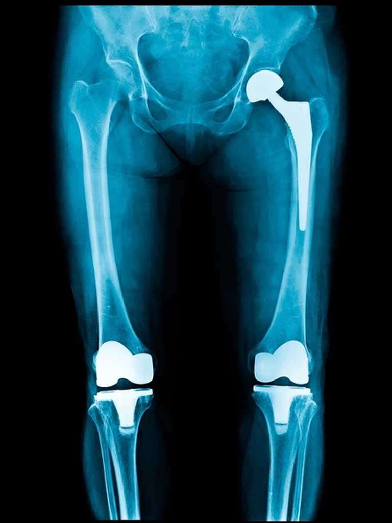 Hip Replacement