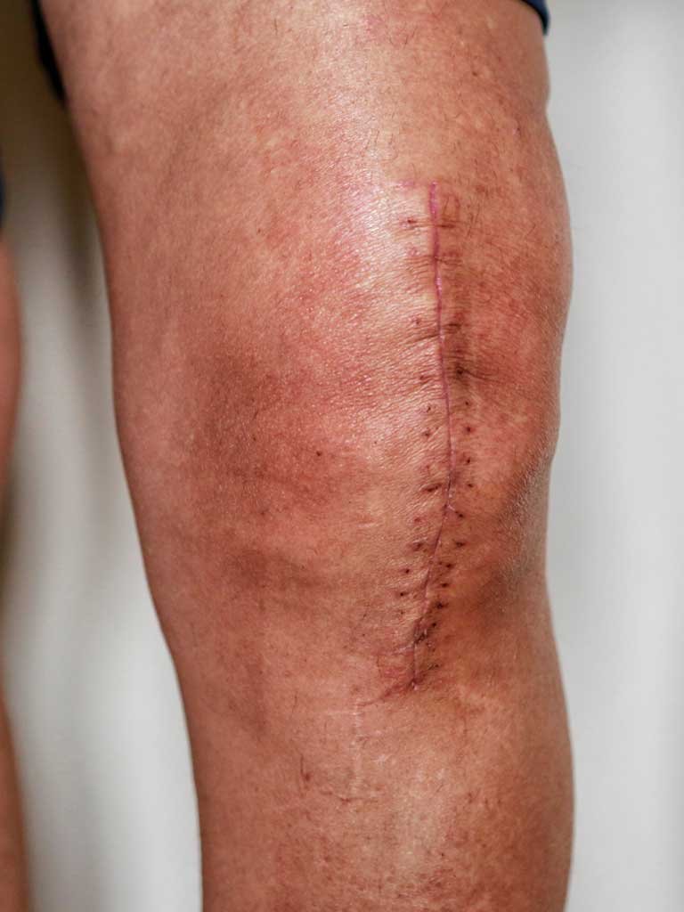 Knee Replacement