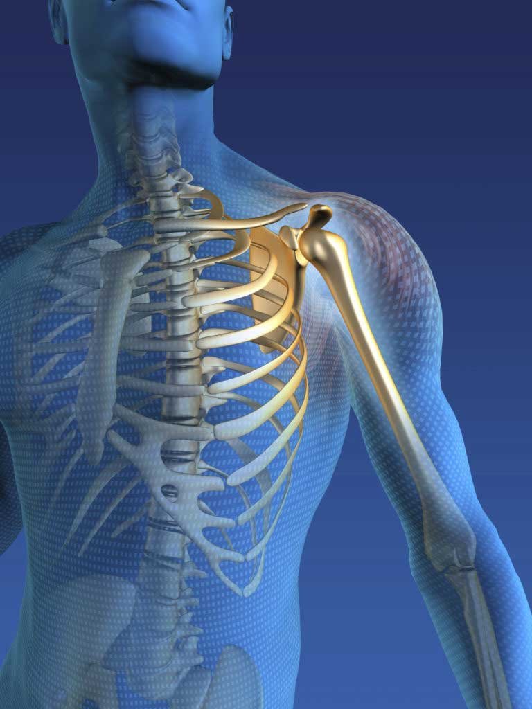 Shoulder Replacement